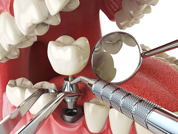 Best Dental Abscess Treatment in Coal Valley, IL